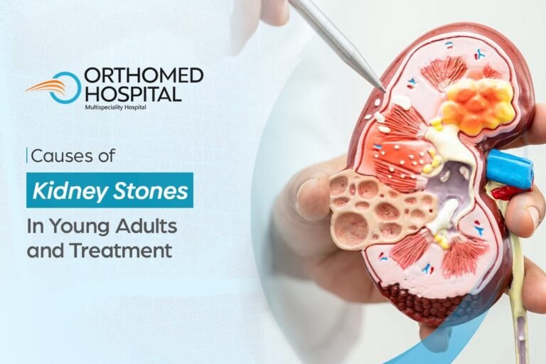 Causes of Kidney Stones in Young Adults and Treatment